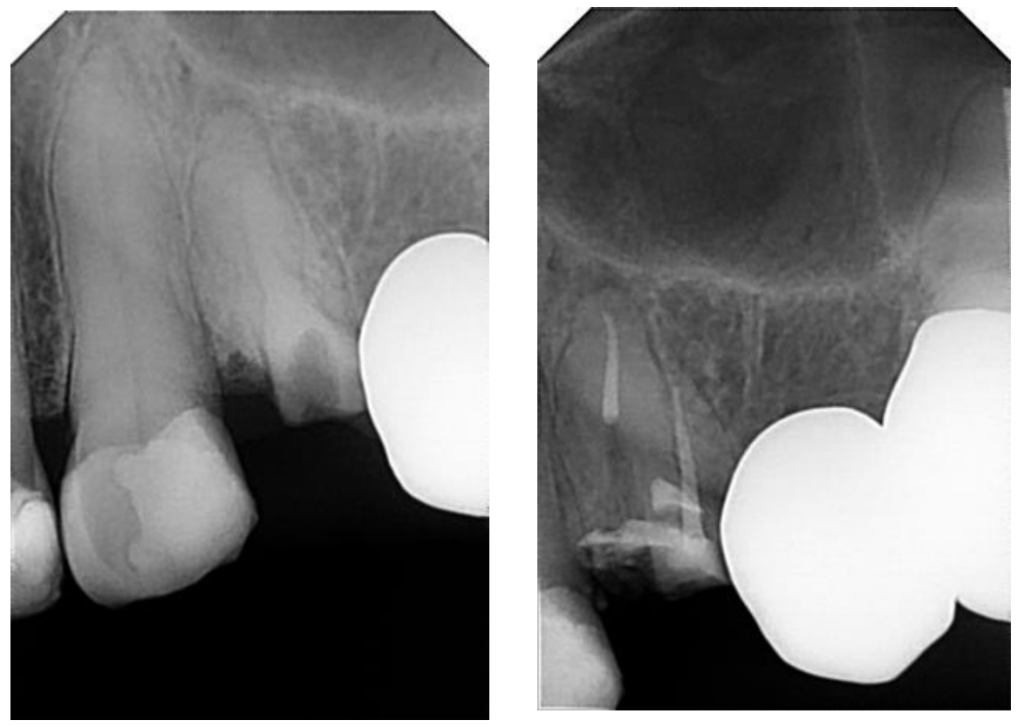 Root Canal Therapy Cosmeti Dentistry Costa Rica