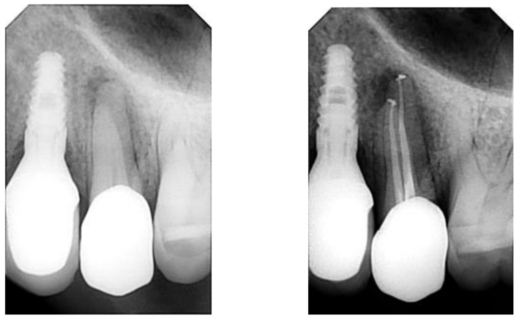 Root Canal Treatment - Cosmetic Dentistry Costa Rica