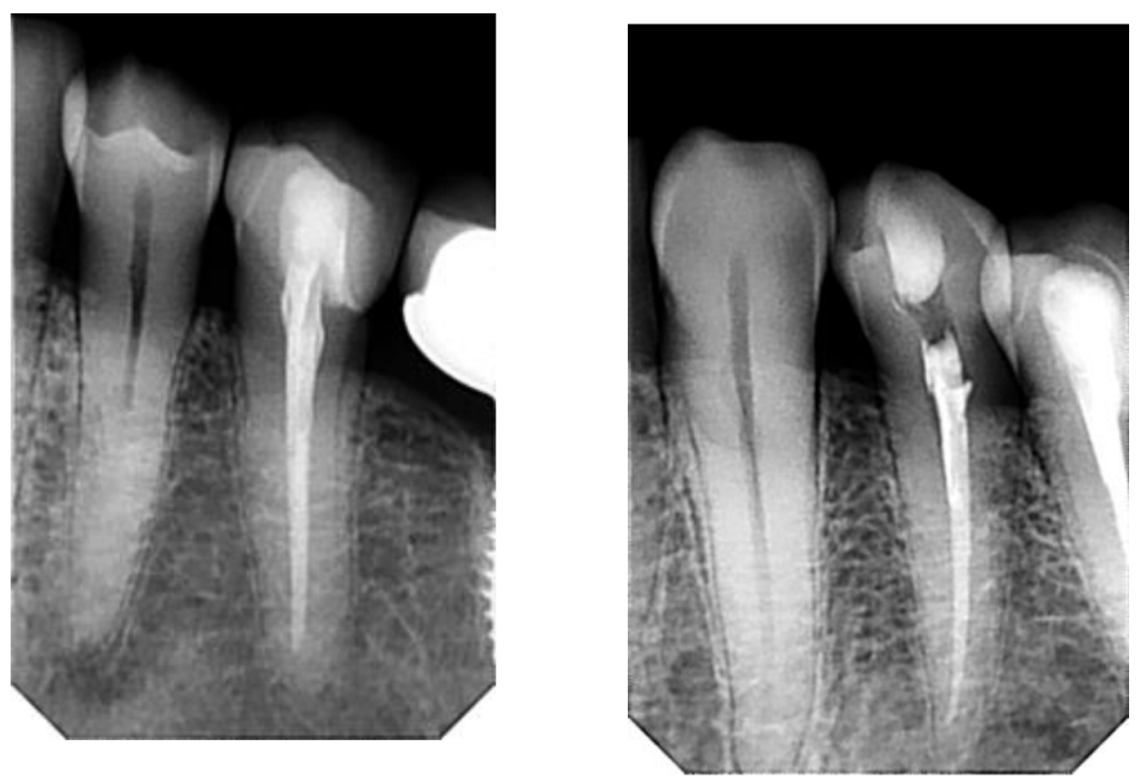 Root Canal Therapy Cosmetic Dentistry Costa Rica