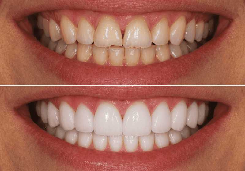 Package Digital Veneers