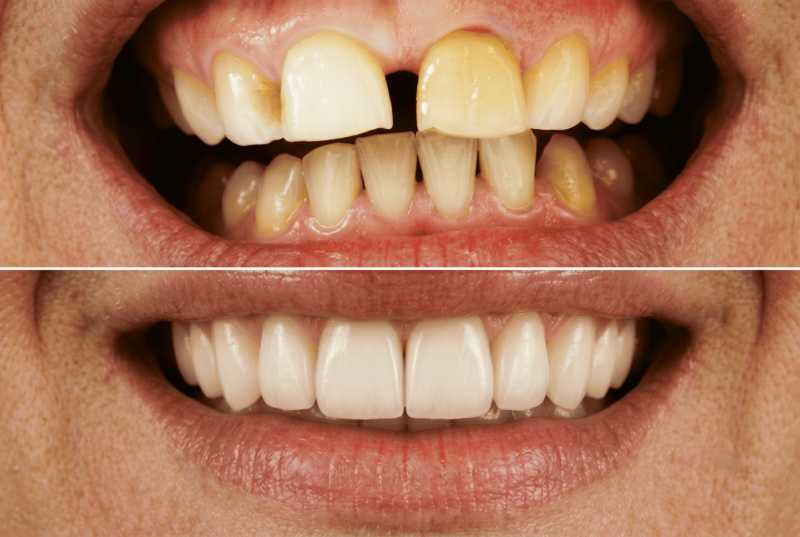 Total Mouth Reconstruction in Costa Rica