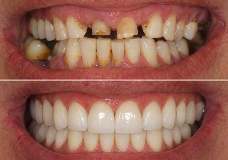 Package Total Mouth Reconstruction Zirconia Crowns and Bridges